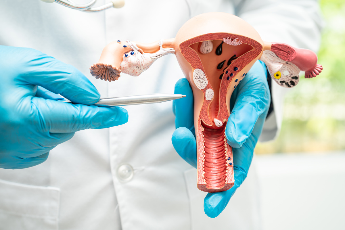 Uterus, doctor holding anatomy model for study diagnosis and tre